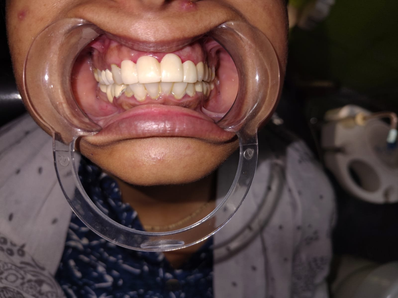 After smile design treatment at Bhati Dental Clinic